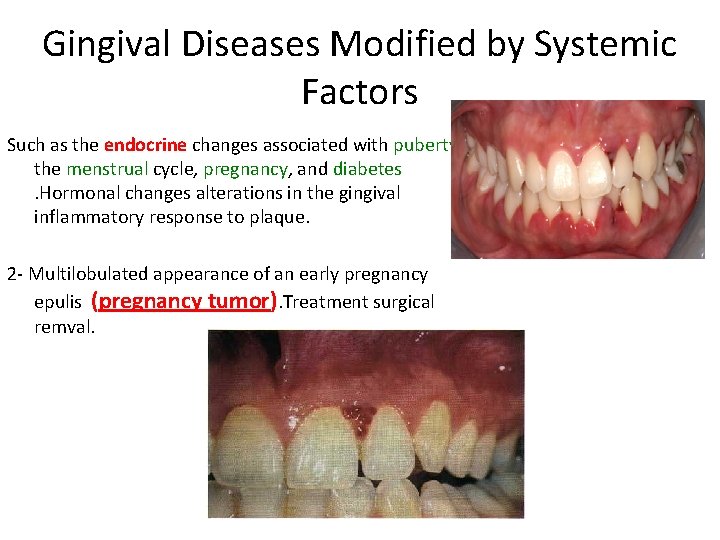 Gingival Diseases Modified by Systemic Factors Such as the endocrine changes associated with puberty, Gingival Diseases Modified by Systemic Factors Such as the endocrine changes associated with puberty,