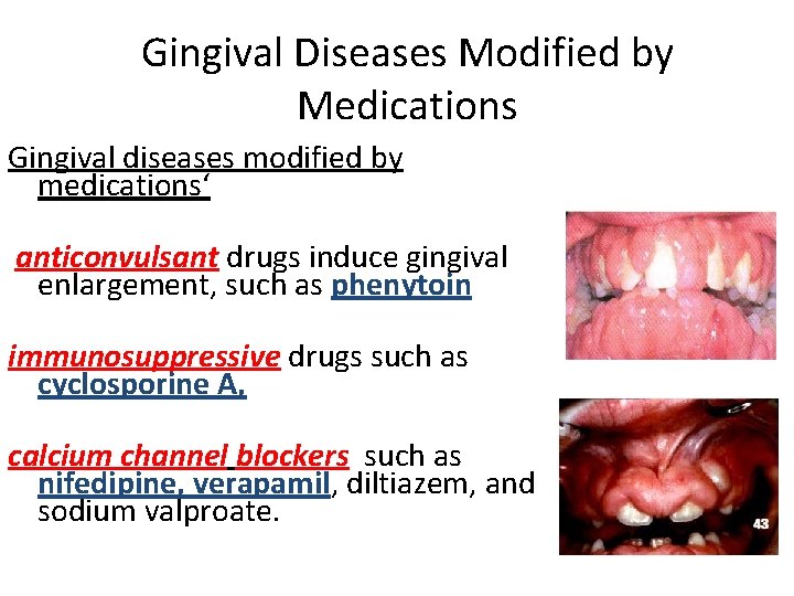 Gingival Diseases Modified by Medications Gingival diseases modified by medications‘ anticonvulsant drugs induce gingival Gingival Diseases Modified by Medications Gingival diseases modified by medications‘ anticonvulsant drugs induce gingival