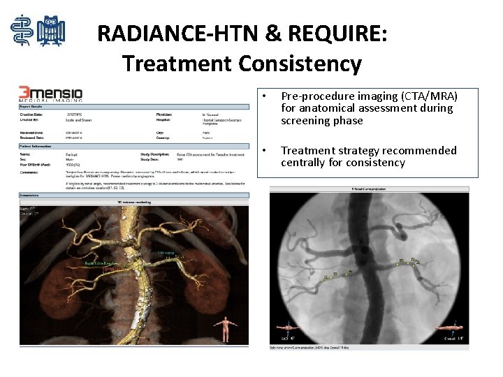 RADIANCE-HTN & REQUIRE: Treatment Consistency • Pre-procedure imaging (CTA/MRA) for anatomical assessment during screening