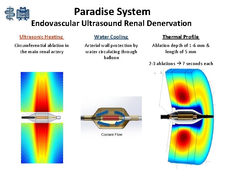 Paradise System Endovascular Ultrasound Renal Denervation Ultrasonic Heating Water Cooling Thermal Profile Circumferential ablation