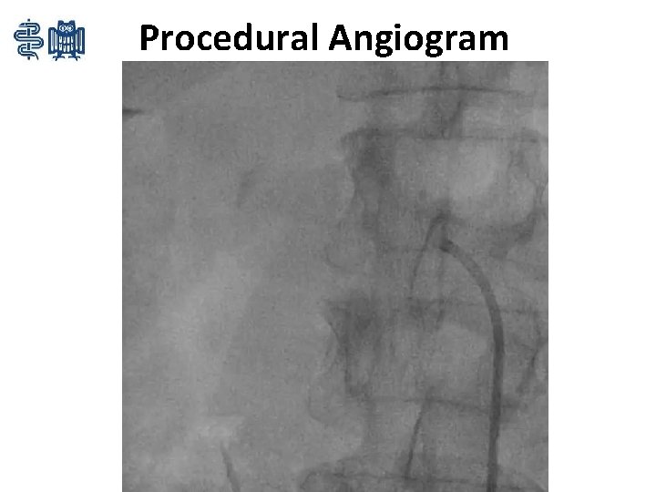 Procedural Angiogram 