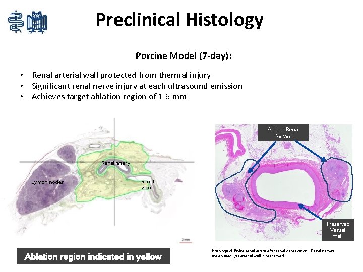 Preclinical Histology Porcine Model (7 -day): • Renal arterial wall protected from thermal injury