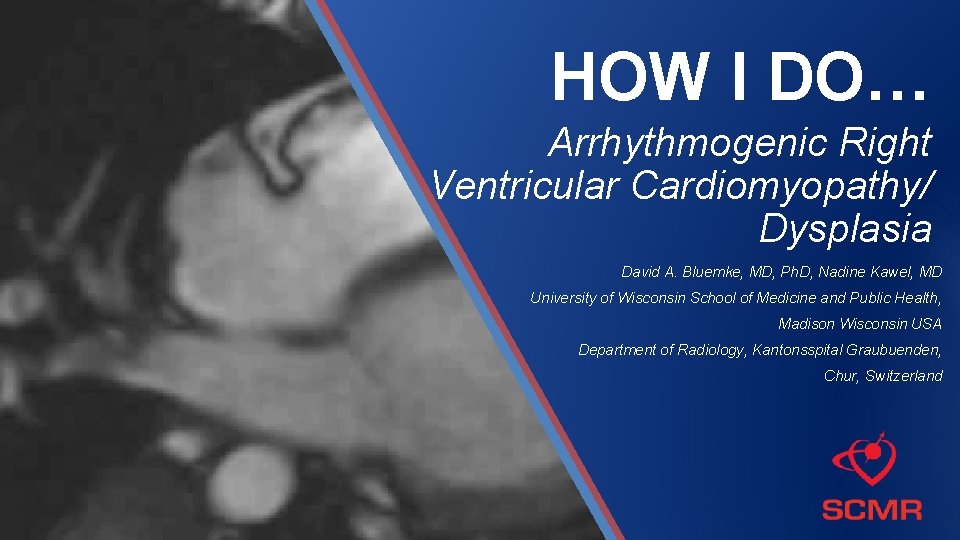 HOW I DO… Arrhythmogenic Right Ventricular Cardiomyopathy/ Dysplasia David A. Bluemke, MD, Ph. D,