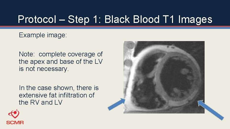 Protocol – Step 1: Black Blood T 1 Images Example image: Note: complete coverage