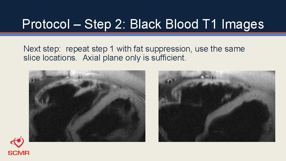 Protocol – Step 2: Black Blood T 1 Images Next step: repeat step 1