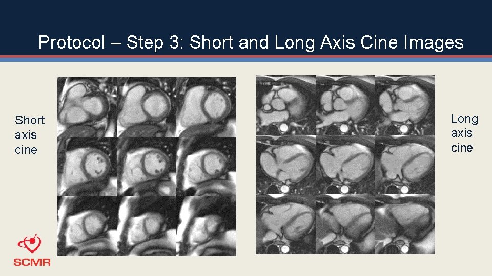 Protocol – Step 3: Short and Long Axis Cine Images Short axis cine Long