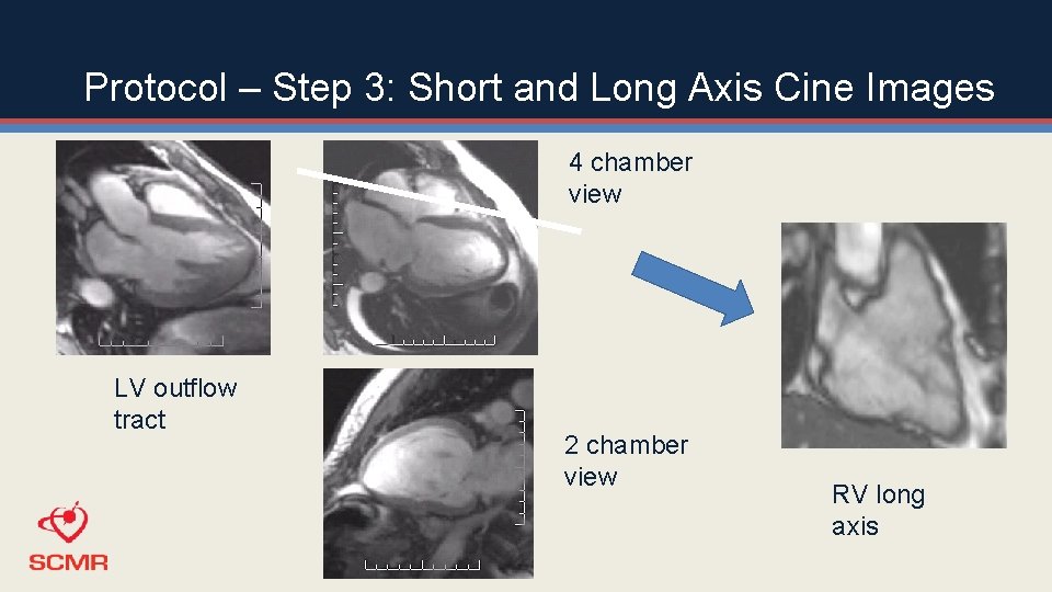 Protocol – Step 3: Short and Long Axis Cine Images 4 chamber view LV