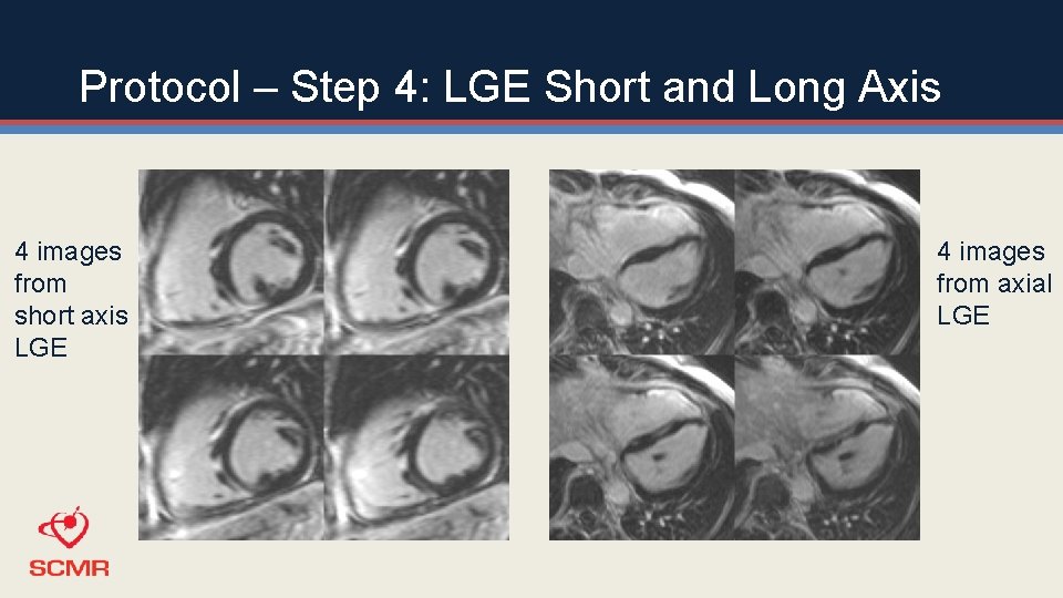 Protocol – Step 4: LGE Short and Long Axis 4 images from short axis