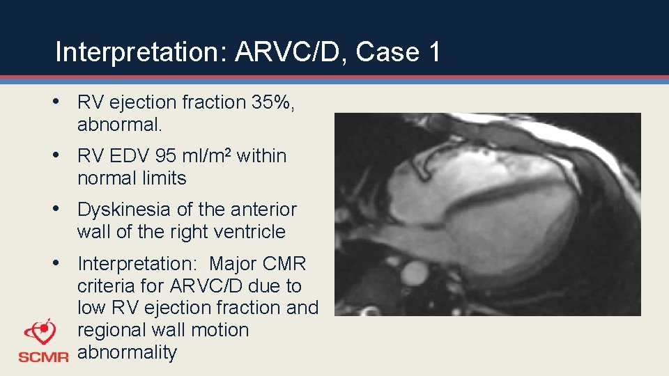 Interpretation: ARVC/D, Case 1 • RV ejection fraction 35%, abnormal. • RV EDV 95