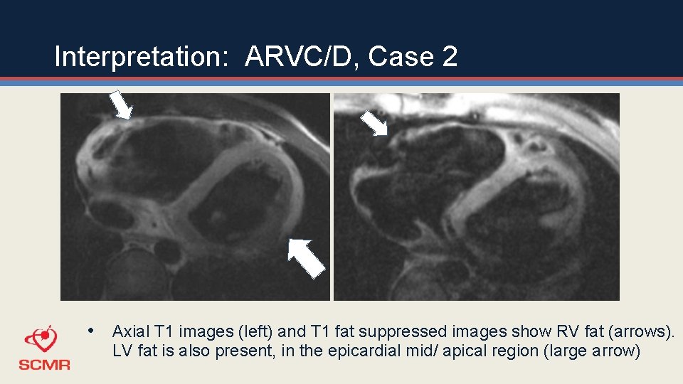 Interpretation: ARVC/D, Case 2 • Axial T 1 images (left) and T 1 fat
