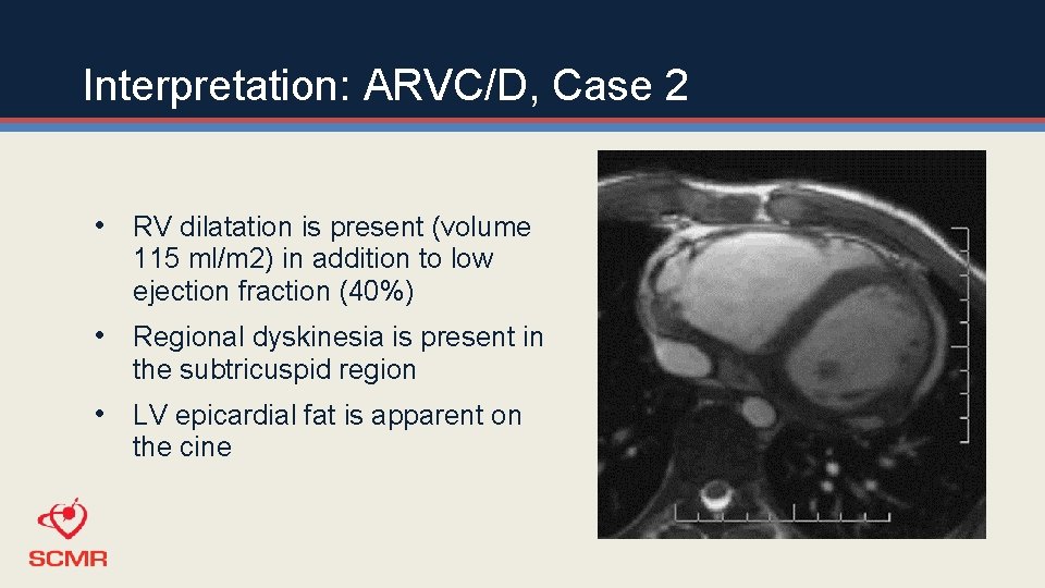 Interpretation: ARVC/D, Case 2 • RV dilatation is present (volume 115 ml/m 2) in