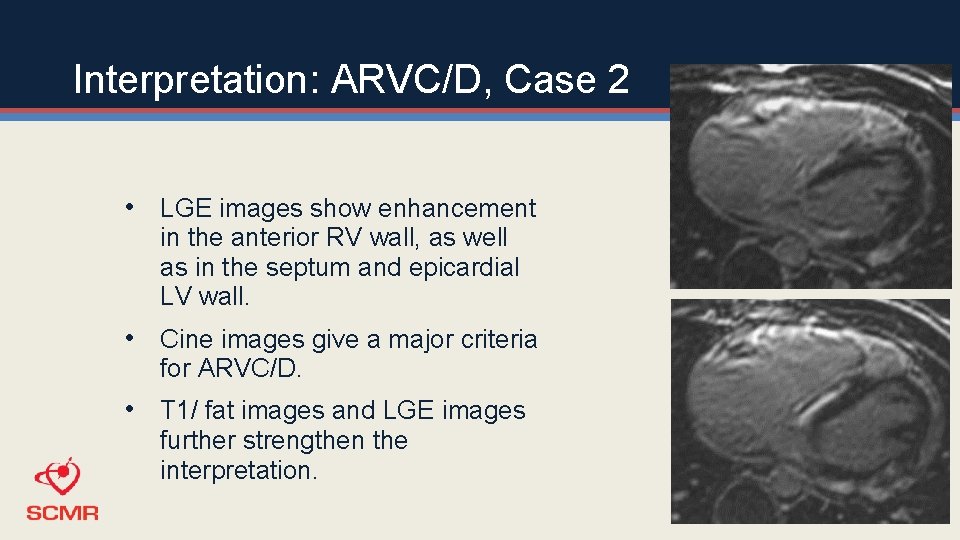 Interpretation: ARVC/D, Case 2 • LGE images show enhancement in the anterior RV wall,