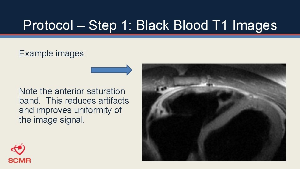 Protocol – Step 1: Black Blood T 1 Images Example images: Note the anterior