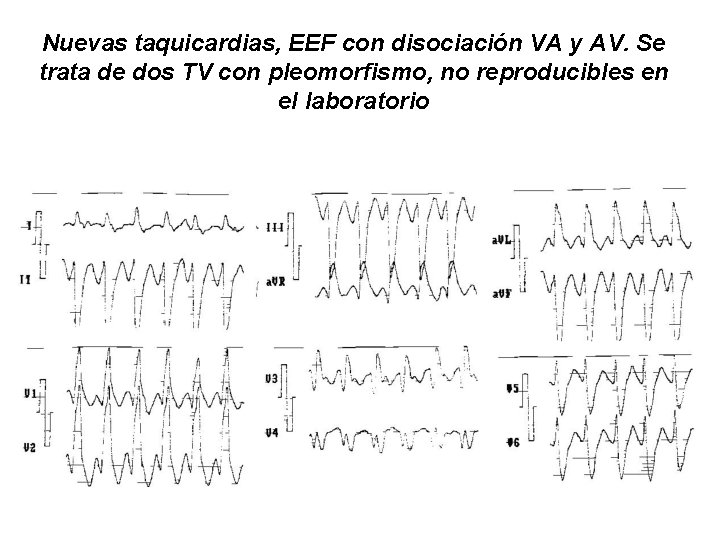 Nuevas taquicardias, EEF con disociación VA y AV. Se trata de dos TV con