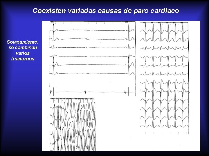 Coexisten variadas causas de paro cardiaco Solapamiento, se combinan varios trastornos 