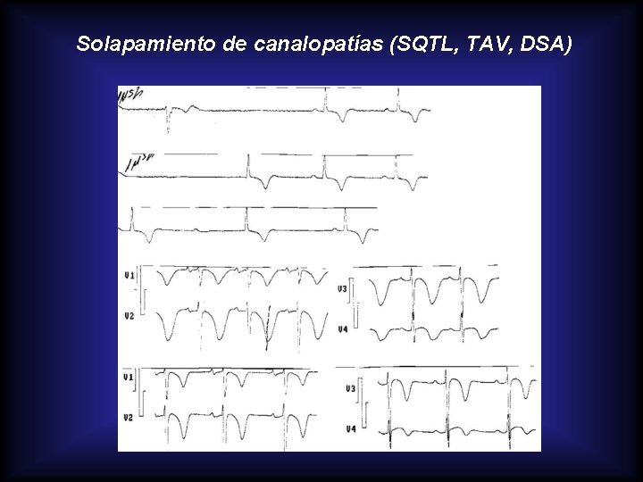 Solapamiento de canalopatías (SQTL, TAV, DSA) 