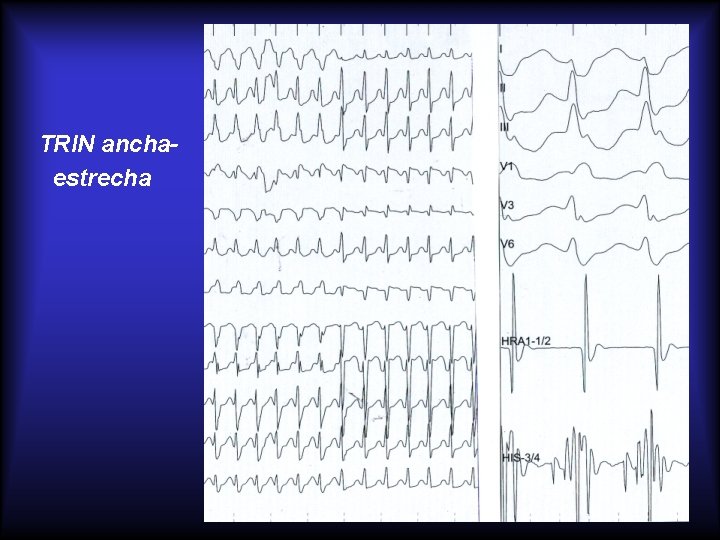 TRIN anchaestrecha 