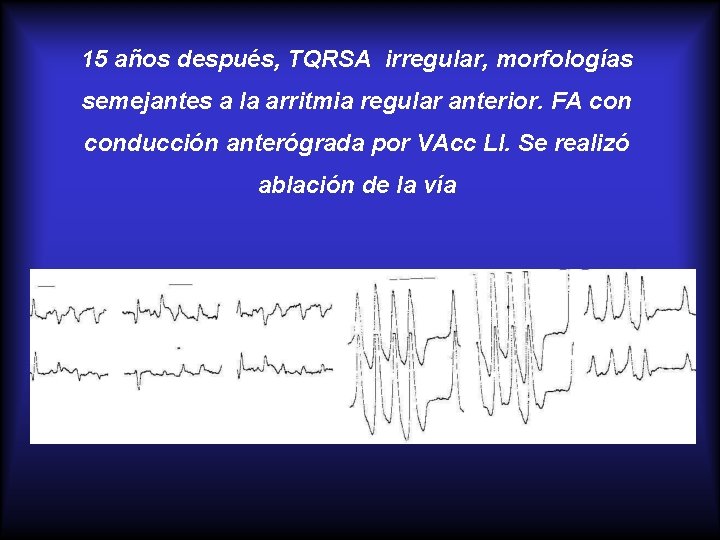 15 años después, TQRSA irregular, morfologías semejantes a la arritmia regular anterior. FA conducción