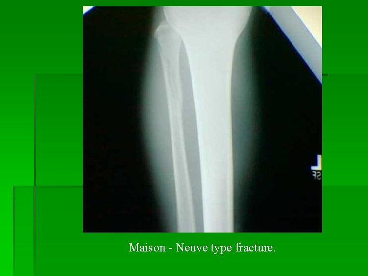 Maison - Neuve type fracture. 