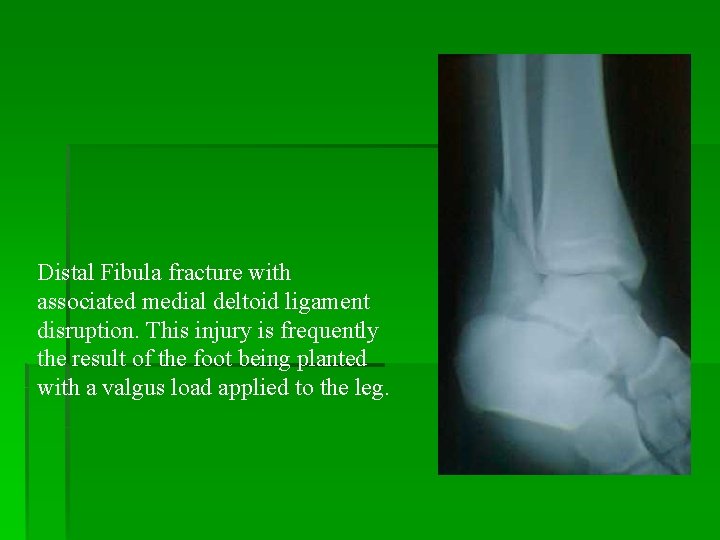 Distal Fibula fracture with associated medial deltoid ligament disruption. This injury is frequently the