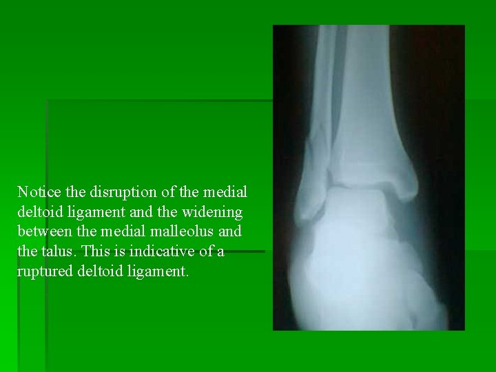 Notice the disruption of the medial deltoid ligament and the widening between the medial