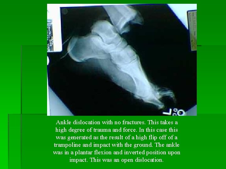 Ankle dislocation with no fractures. This takes a high degree of trauma and force.