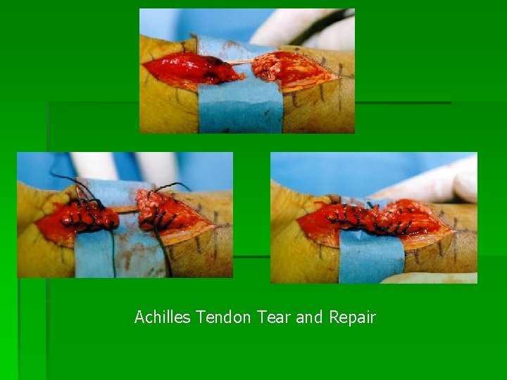 Achilles Tendon Tear and Repair 