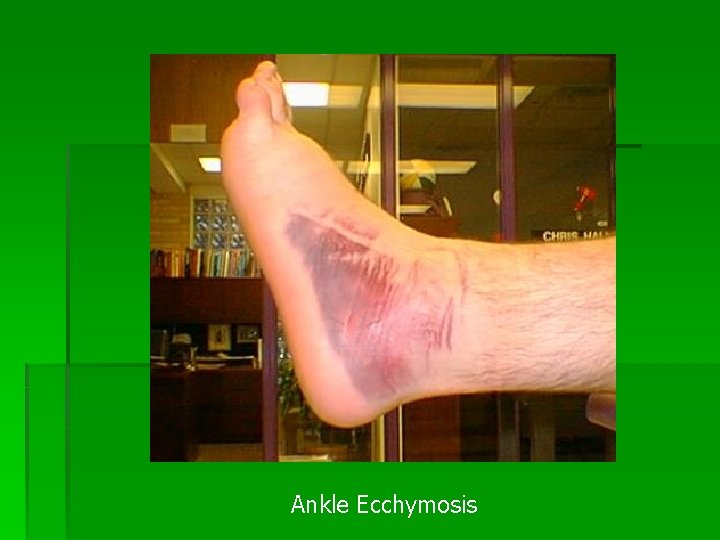 Ankle Ecchymosis 