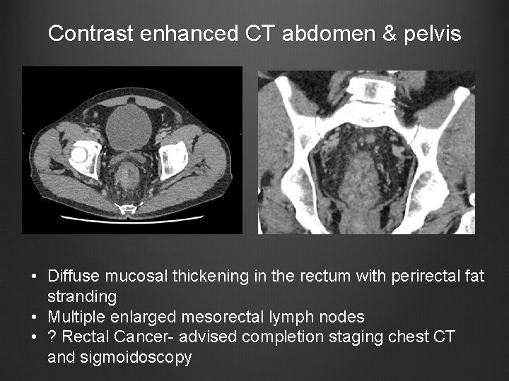 Contrast enhanced CT abdomen & pelvis • Diffuse mucosal thickening in the rectum with