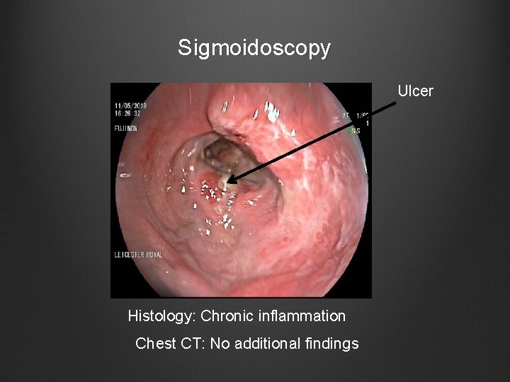 Sigmoidoscopy Ulcer Histology: Chronic inflammation Chest CT: No additional findings 