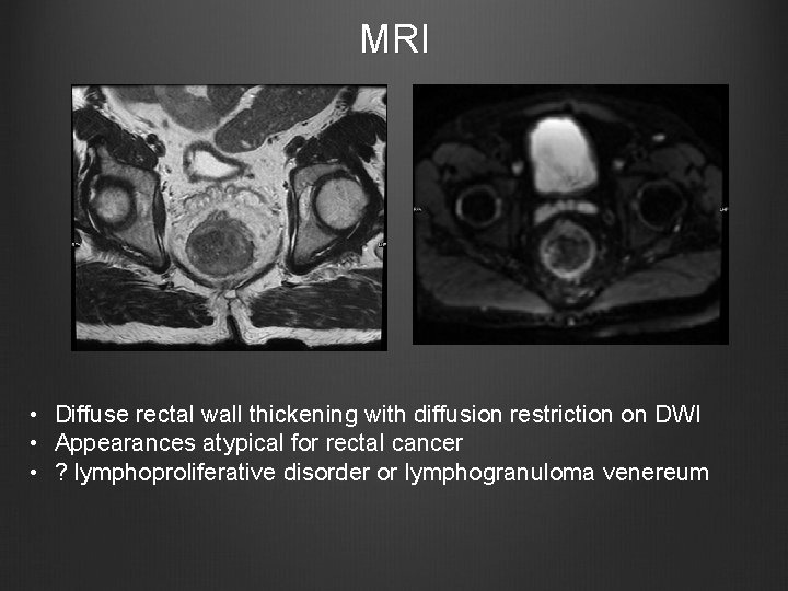 MRI • Diffuse rectal wall thickening with diffusion restriction on DWI • Appearances atypical