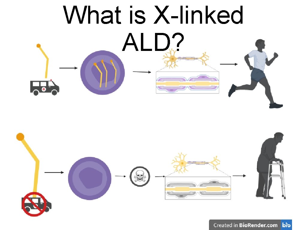What is X-linked ALD? 