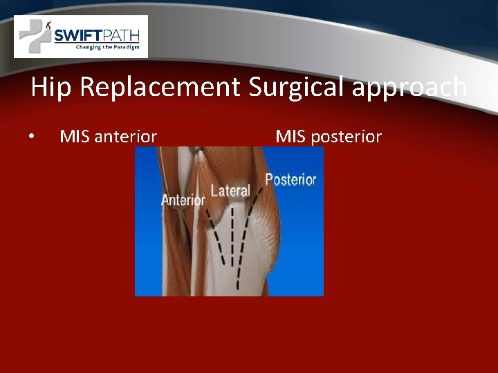 Hip Replacement Surgical approach • MIS anterior MIS posterior 