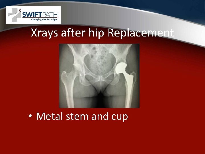 Xrays after hip Replacement • Metal stem and cup 