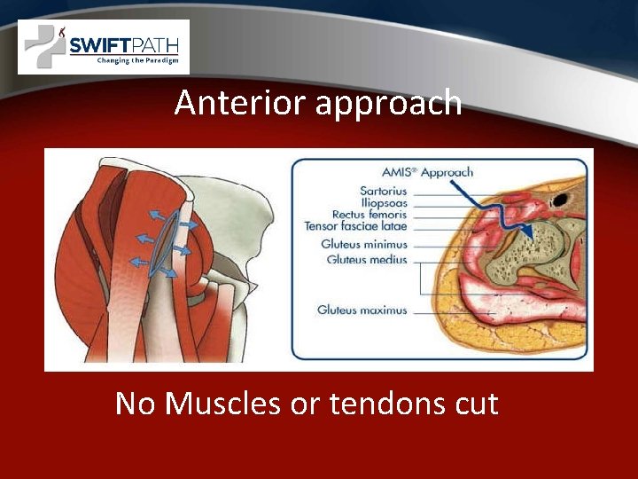 Anterior approach No Muscles or tendons cut 