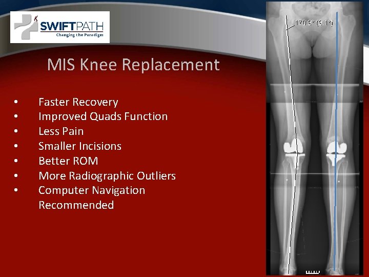 MIS Knee Replacement • • Faster Recovery Improved Quads Function Less Pain Smaller Incisions