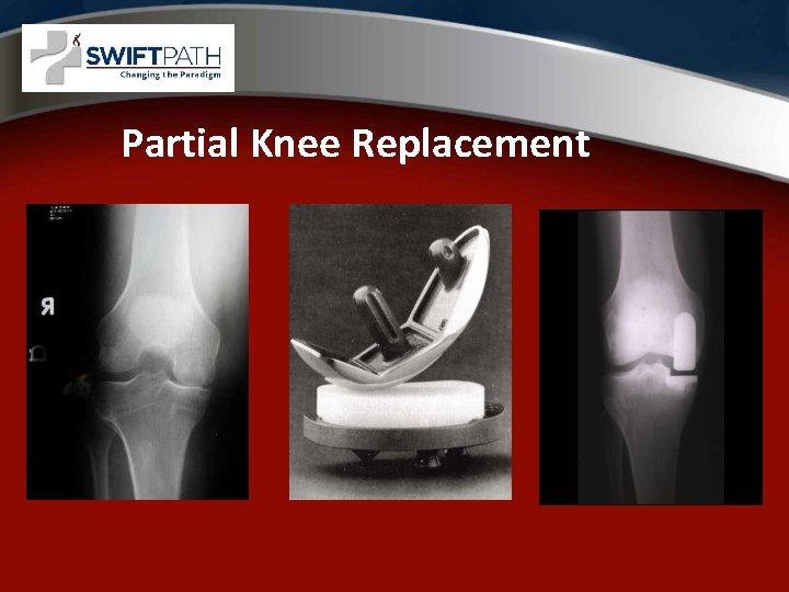 Partial Knee Replacement 