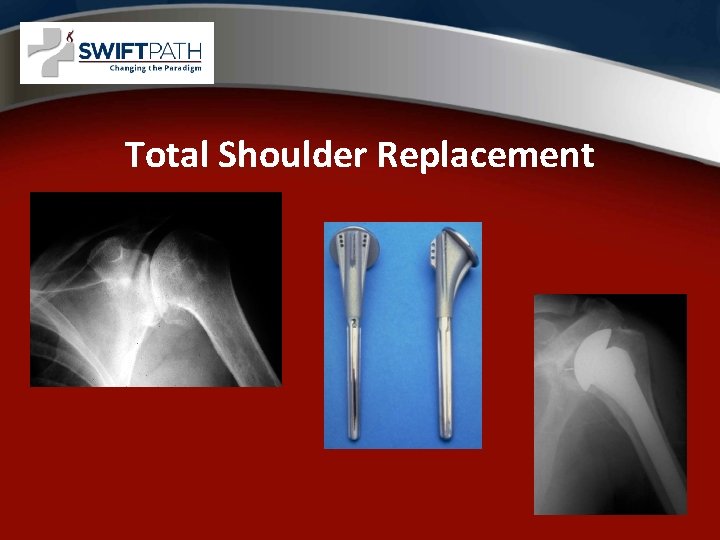 Total Shoulder Replacement 