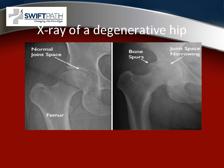 X-ray of a degenerative hip 