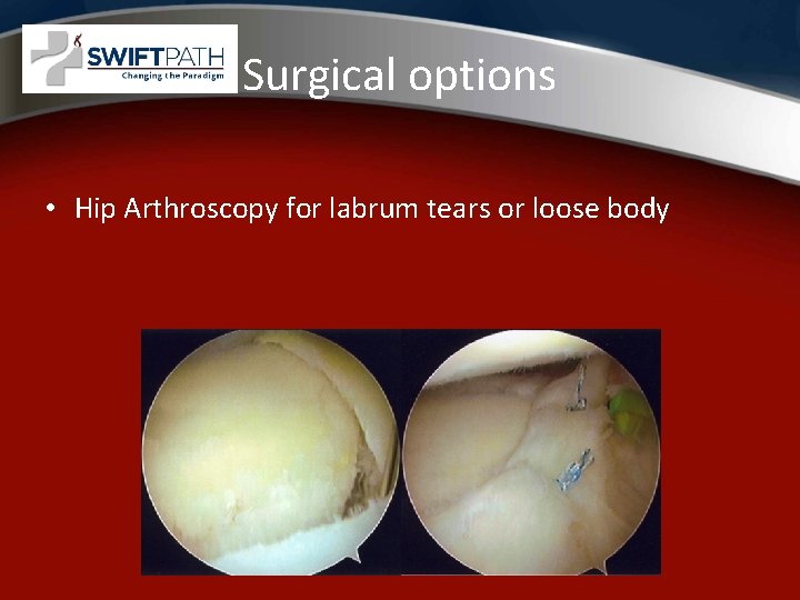 Surgical options • Hip Arthroscopy for labrum tears or loose body 