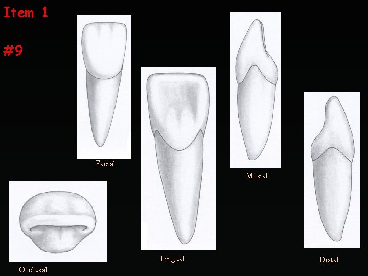 Item 1 #9 Facial Mesial Lingual Occlusal Distal 