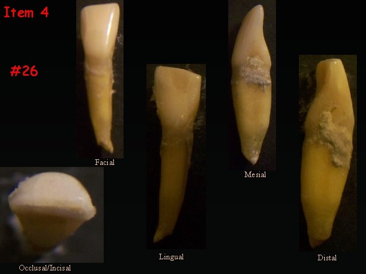 Item 4 #26 Facial Mesial Lingual Occlusal/Incisal Distal 