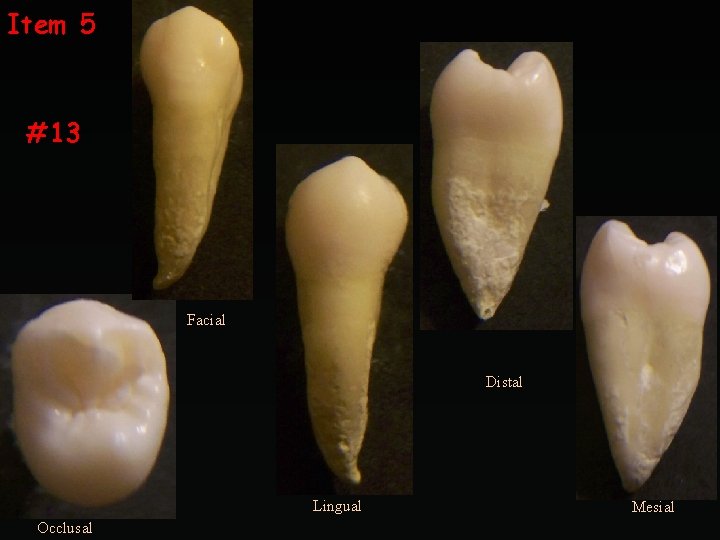 Item 5 #13 Facial Distal Lingual Occlusal Mesial 