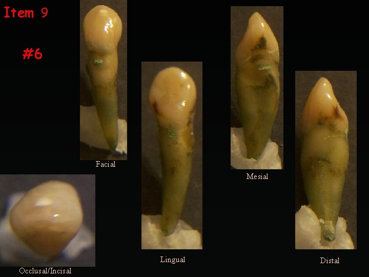 Item 9 #6 Facial Mesial Lingual Occlusal/Incisal Distal 