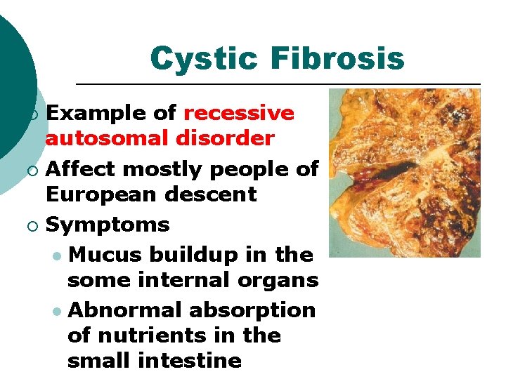 Cystic Fibrosis Example of recessive autosomal disorder ¡ Affect mostly people of European descent Cystic Fibrosis Example of recessive autosomal disorder ¡ Affect mostly people of European descent