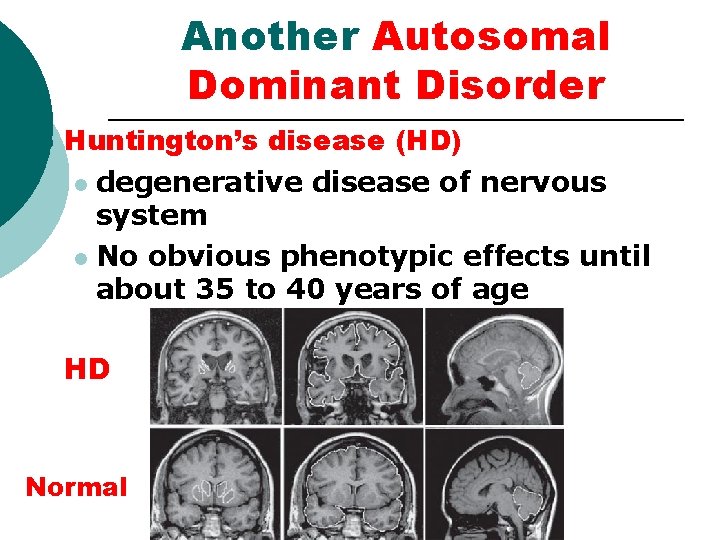 Another Autosomal Dominant Disorder ¡ Huntington’s disease (HD) l degenerative disease of nervous system Another Autosomal Dominant Disorder ¡ Huntington’s disease (HD) l degenerative disease of nervous system