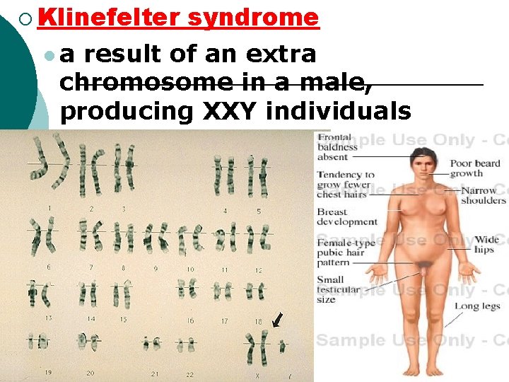 ¡ Klinefelter syndrome l a result of an extra chromosome in a male, producing ¡ Klinefelter syndrome l a result of an extra chromosome in a male, producing