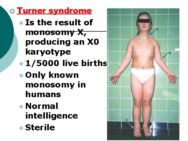 ¡ Turner syndrome l Is the result of monosomy X, producing an X 0 ¡ Turner syndrome l Is the result of monosomy X, producing an X 0