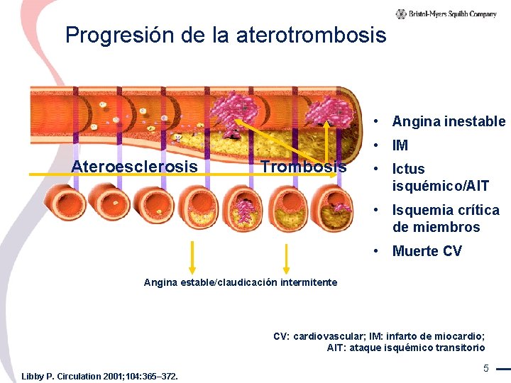 Progresión de la aterotrombosis • Angina inestable • IM Ateroesclerosis Trombosis • Ictus isquémico/AIT