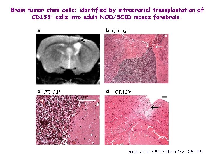 Brain tumor stem cells: identified by intracranial transplantation of CD 133+ cells into adult